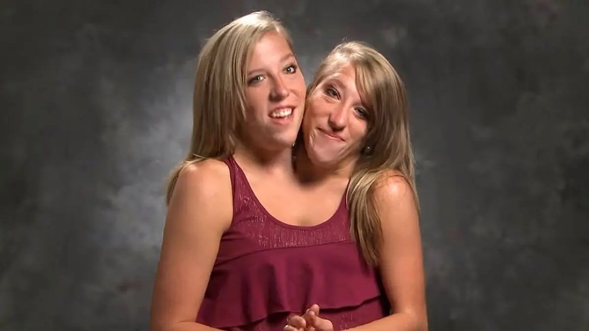 What Happened To Conjoined Twins Abby & Brittany Hensel?